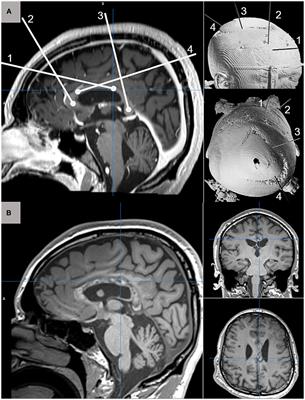 The changing landscape of palliative epilepsy surgery for Lennox Gastaut Syndrome